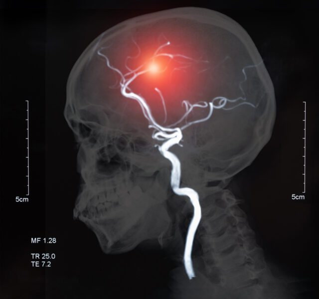 brain stroke