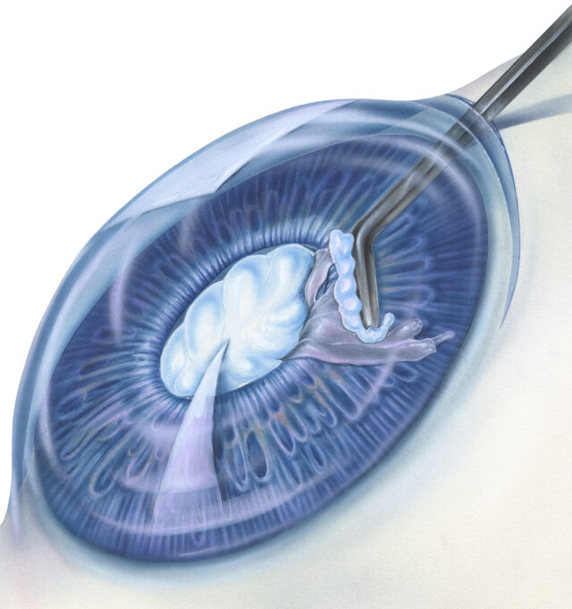 A cataract is an eye disease in which the normally clear lens of