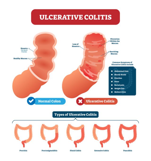 Ulcerative colitis vector illustration. Labeled anatomical infog