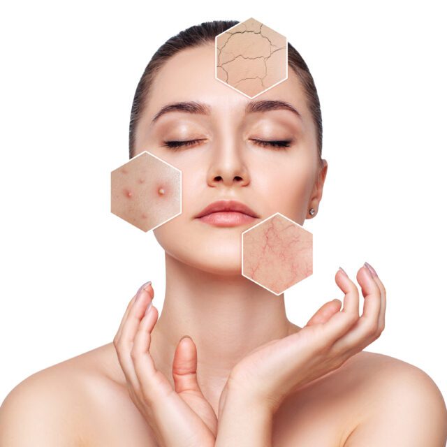 Woman with couperose and acne on face skin. Zoom hexagon shows skin problem.